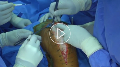 Mediale Gonarthrose mit juxtaartikulärer tibialer Varusdeformität