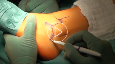 Fibulare Bandplastik bei chronischer lateraler Instabilität am oberen Sprunggelenk