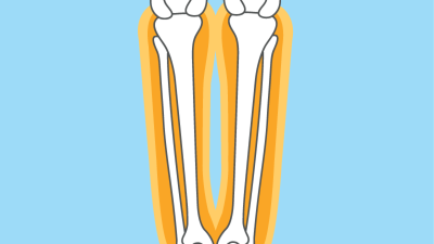 OP-Training - Oberarm