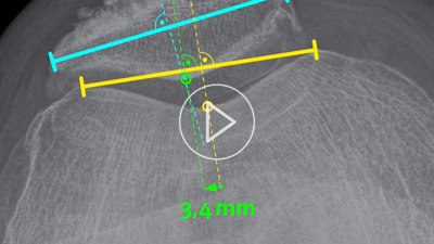 Patellanavigation bei computerassistierter Knie-TEP-Implantation