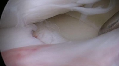 Tibiakopfimpressionsfrakturen 