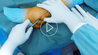 Osteosynthese einer distalen Fibulafraktur mithilfe von IlluminOss