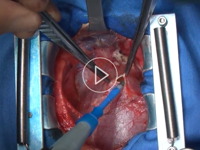 Atriumseptumdefekt