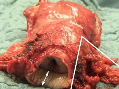 Radikales Hysterektomiepräparat