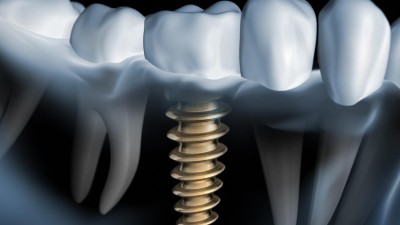 Implantaattheorie Picture