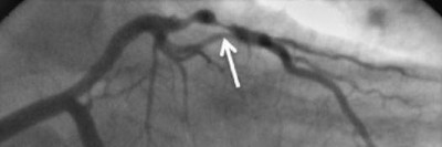 CT-Koronarangiographie eines Patienten mit Plaque im RIVA