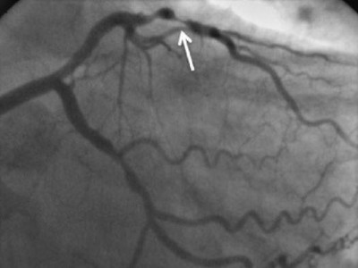 CT-Koronarangiographie eines Patienten mit Plaque im RIVA