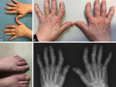 Psoriasisarthritis 