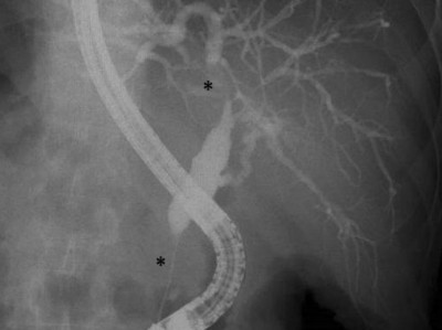 Doppelstenose des Ductus hepatocholedochus