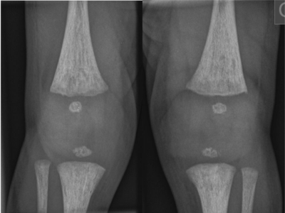 Röntgenaufnahme der Knie eines Neugeborenen