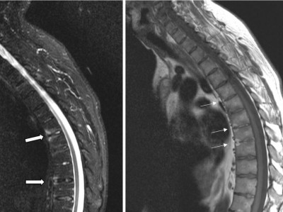 Wirbelsäulen-MRT bei Patient mit axialer Spondyloarthritis