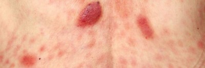 Kutanes zytotoxisches T-Zell-Lymphom