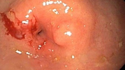 Magenausgangsstenose