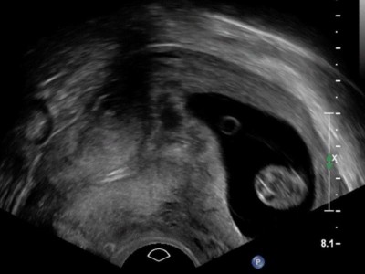 Transvaginalsonographie in der 11+1SSW