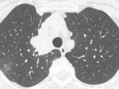 Pulmonales Adenokarzinom bei Diagnosestellung