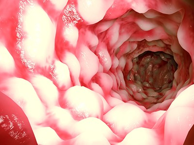 Darm mit Morbus Crohn