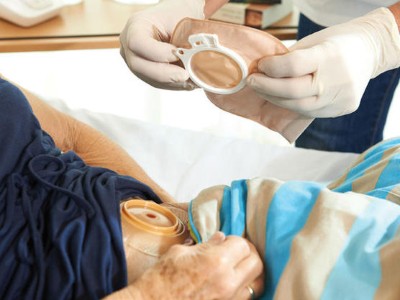 Die Stomaanlage wird trotz der damit verbundenen Einschränkungen nicht selten als Erleichterung wahrgenommen.
