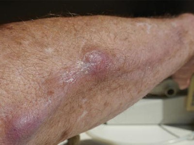 Knotiger Strang am Unterarm