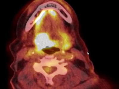 Plattenepithelkarzinom des Oropharynx