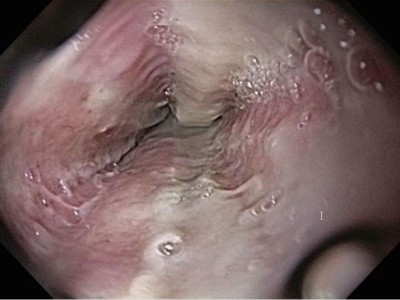 Candida-Ösophagitis