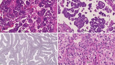 Subtypen des epithelialen Ovarialkarzinoms