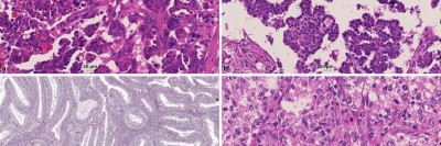 Subtypen des epithelialen Ovarialkarzinoms
