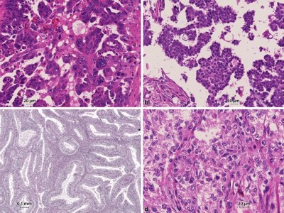 Subtypen des epithelialen Ovarialkarzinoms