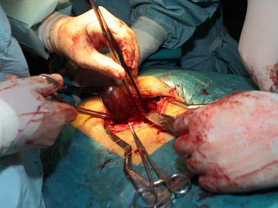 Operation bei Blasenkrebs