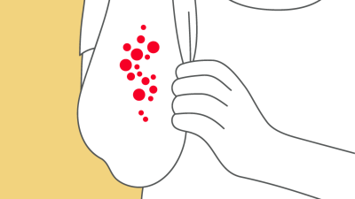 Entzündliche Dermatosen