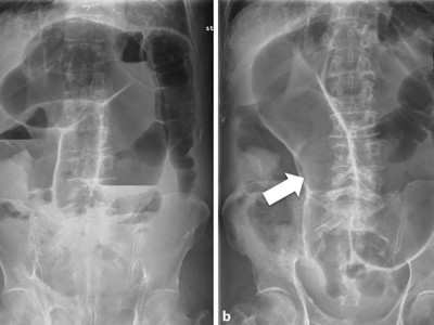 Akutes Abdomen (Röntgenbild)