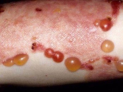 Bullöses Pemphigoid