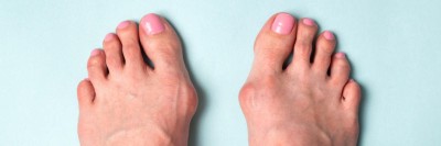 Hallux valgus