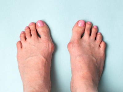 Hallux valgus