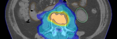 Bestrahlungsplans einer Wirbelsäulenmetastase eines oligometastasierten Prostatakarzinoms
