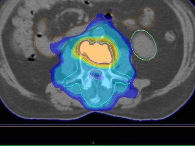 Bestrahlungsplans einer Wirbelsäulenmetastase eines oligometastasierten Prostatakarzinoms