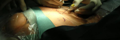 Punktion und Stimulation der Sakralnerven im Foramen ovale 