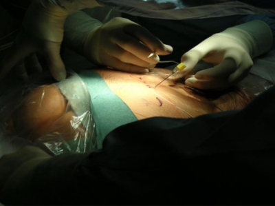 Punktion und Stimulation der Sakralnerven im Foramen ovale 