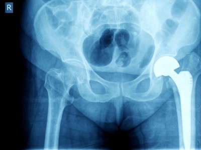 Röntgenbild Hüftprothese