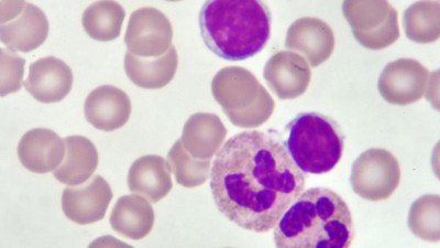 Blutabstrich der chonisch lymphatischen Leukämie