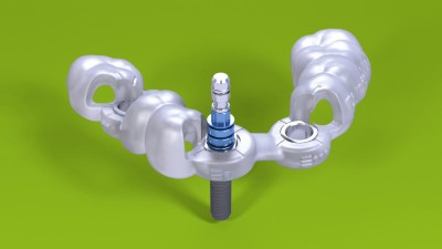 Guided Surgery