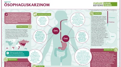 PrimeView Ösophaguskarzinom