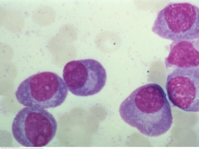 Blutausstrich eines Patienten mit Multiplem Myelom
