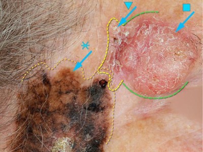 Tumor an der Schläfe