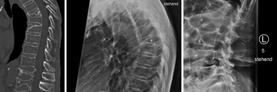 Sinterungsfrakturen der Wirbelsäule