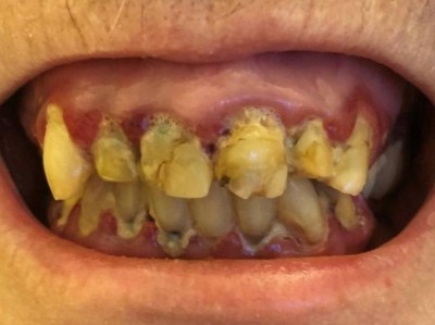 Gingivitis