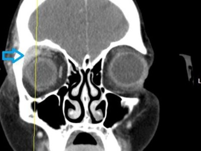 Computertomographie der Nasennebenhöhlen mit Darstellung des intraorbitalen Prozesses