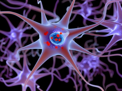Darstellung Morbus Parkinson und Lewy Bodies