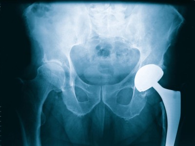 Röntgenbild eines künstlichen Hüftgelenks