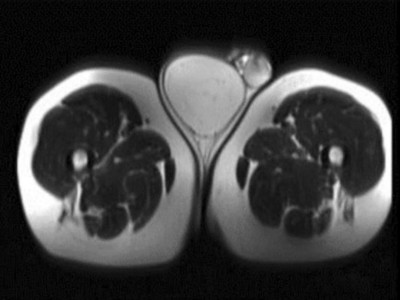 Liposarkom des Funiculus spermaticus