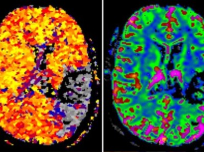 Schlaganfall unter NOAK-Therapie